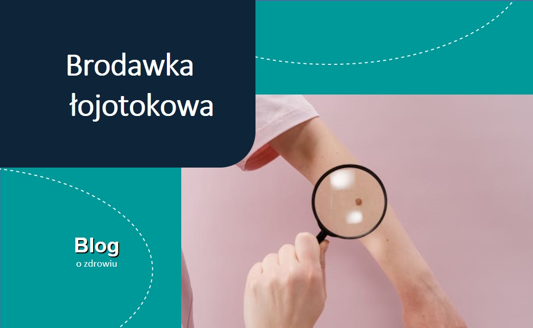 Brodawka łojotokowa 