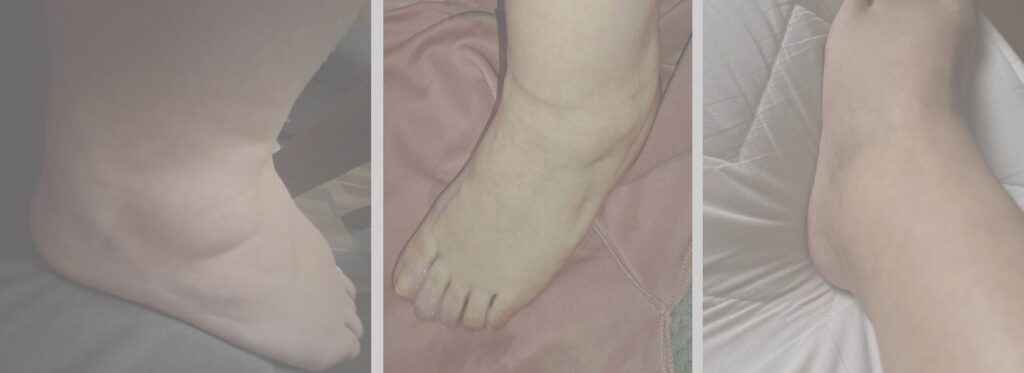 Obrzęk limfatyczny nóg zdjęcia