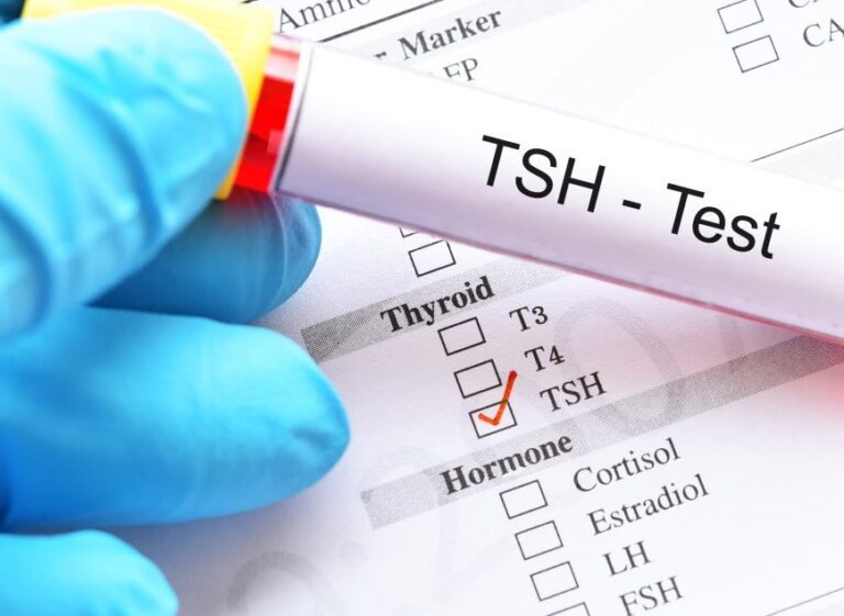 TSH test